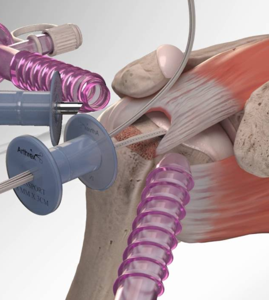Cuff Helper Rotator Cuff Repair - drankit
